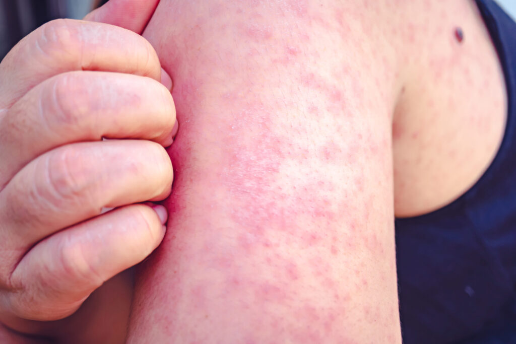 First Measles Case of the Year
