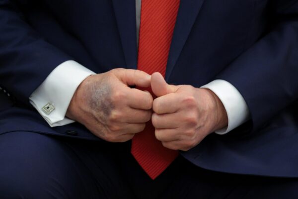 Trump Seen With Bruised Right Hand
