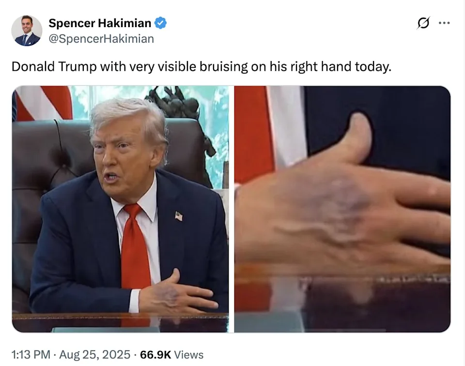 Trump Seen With Bruised Right Hand